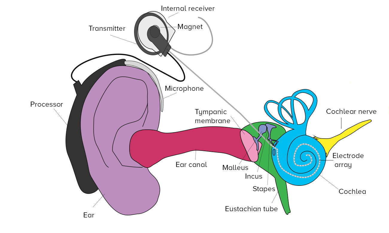 cochlear implant
