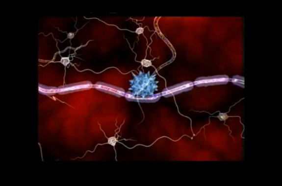 Promising Results in Early Trial of Novel MS Treatment