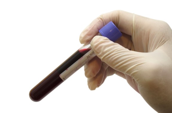 Could a Blood Test Help Diagnose Alzheimer’s?
