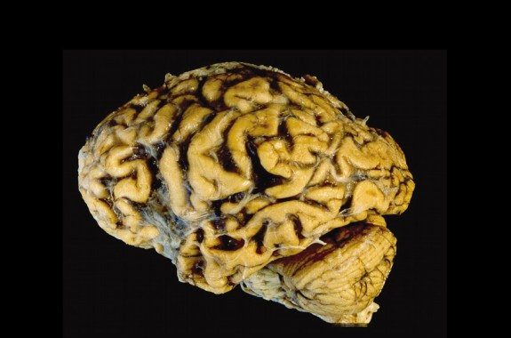 Attacking Alzheimer’s with Antibodies, Hormones