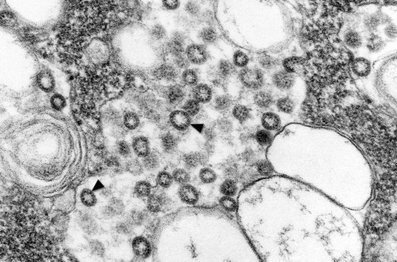 a black and white microscope image that shows many circles. smaller circles with thick black edges (the corona) are the SARS coronavirus.