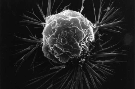 a black and white image of a breast cancer cell, photographed by a scanning electron microscope. it's a 3D image of a round bumpy cell, with binding sites coming off it