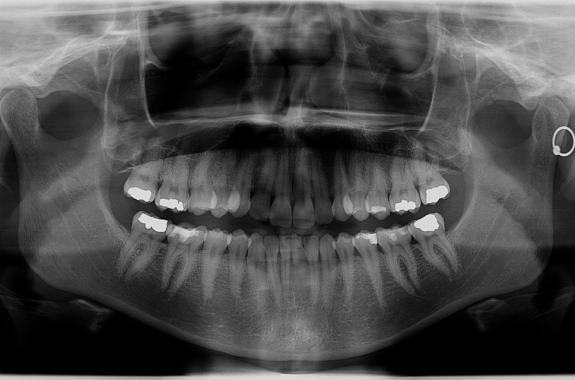 a full panorama x-ray of a person's mouth which reveals teeth, roots, and fillings