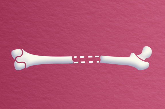 broken cartoon bone with dotted lines connecting them against a wine-colored, paper-textured background