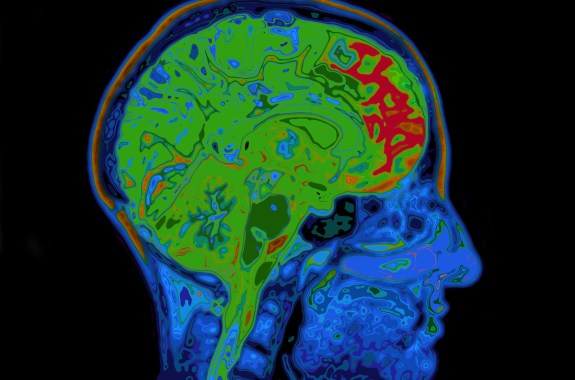 MRI image of head showing the brain