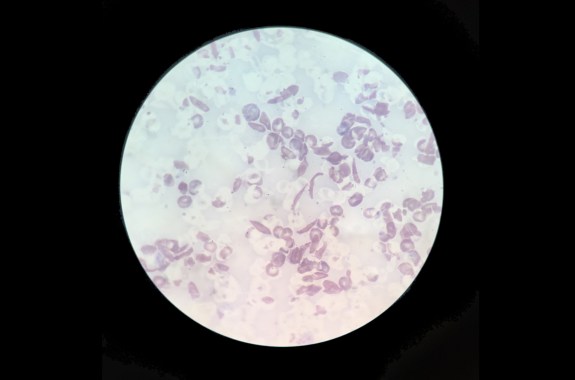 Blood cells floating under a microscope view. Some look broken and stripped.