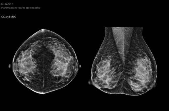 X-ray Digital Mammogram of Both side CC view and MLO view. mammography or breast scan for Breast cancer BI-RADS 1 mammogram results are negative.